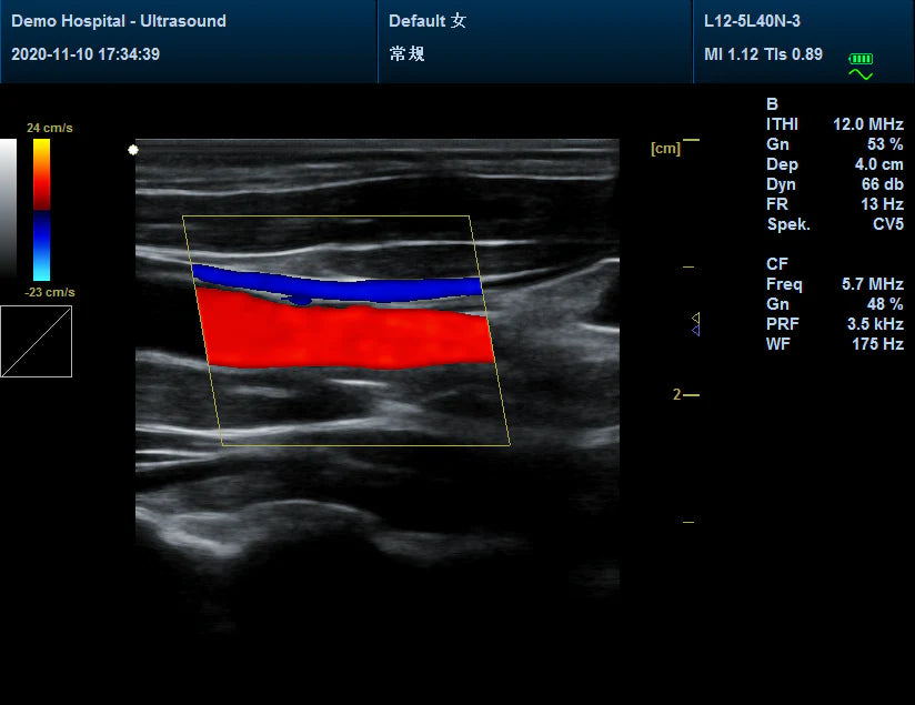 CMS1700C Portable Color Ultrasound Scanner